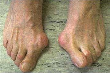 Hallux valgus schoen na operatie online